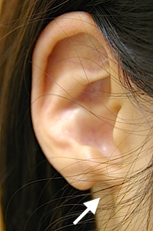 耳垂裂の写真