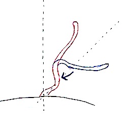 立ち耳の糸による手術