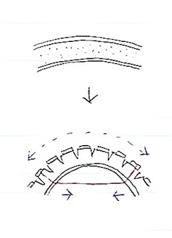 弾性軟骨の矯正