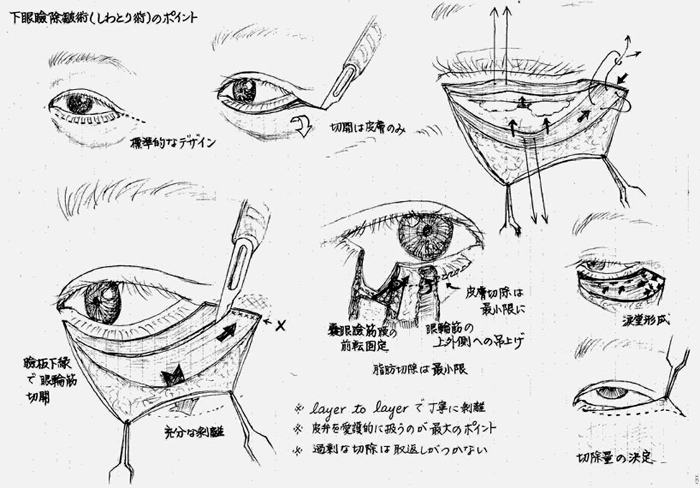 たるみ取り手術のポイント図解 たるみ取り手術のポイント