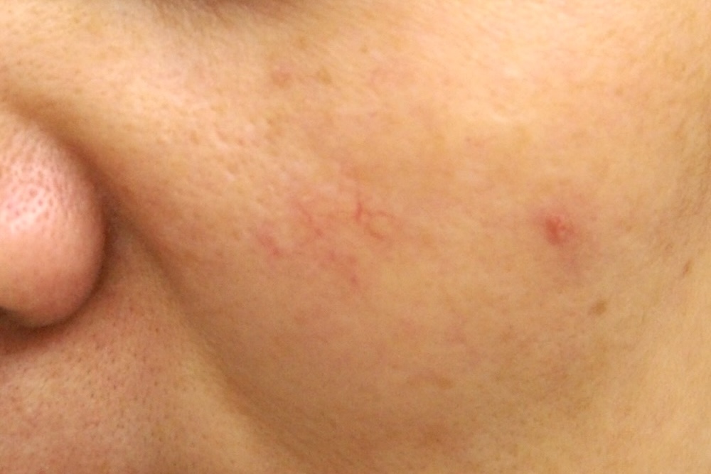 デトックス治療中　大江橋クリニック