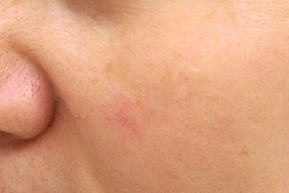 デトックス治療中　大江橋クリニック