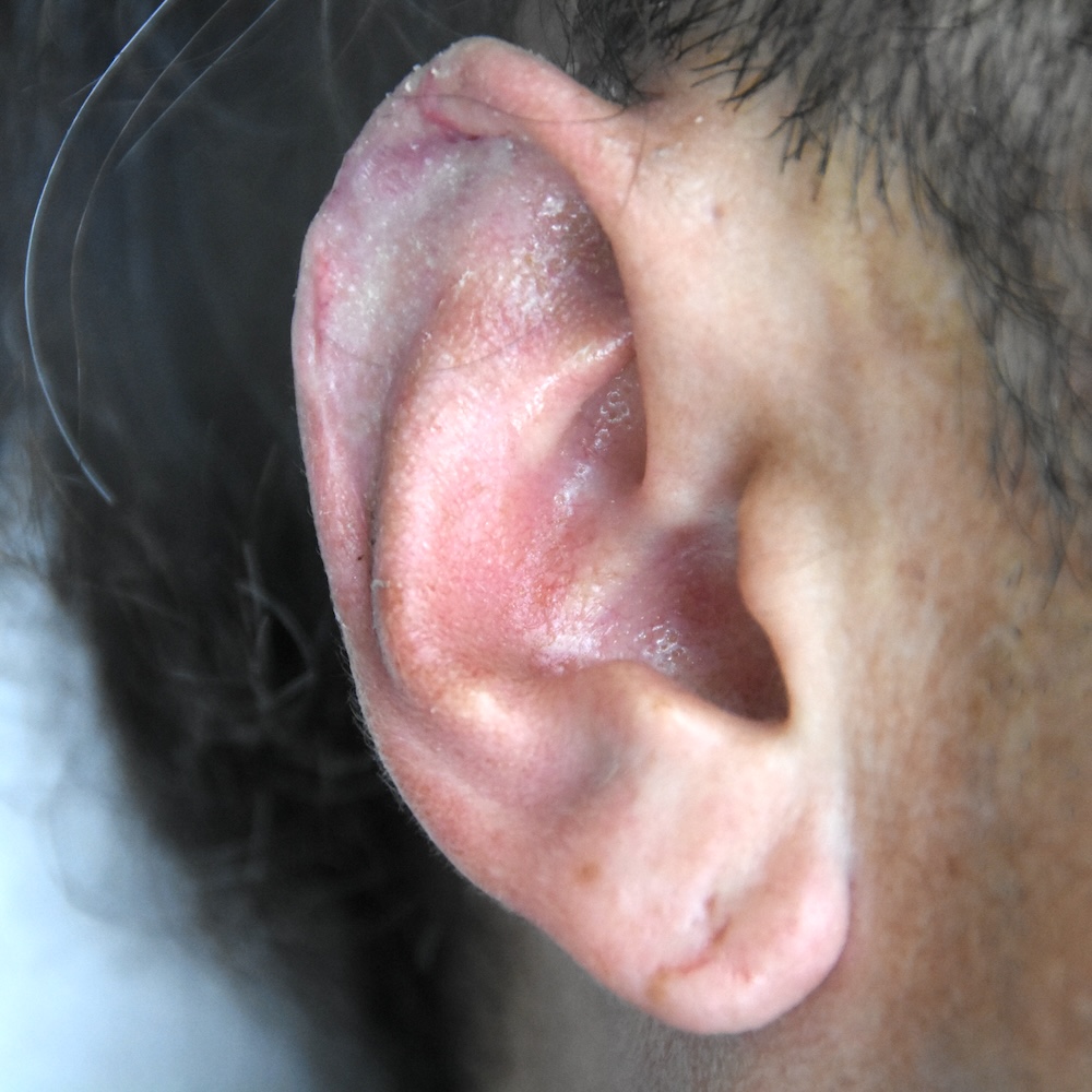 耳介欠損術後　大江橋クリニック