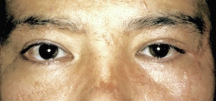 男性顔面外傷瘢痕術後　大江橋クリニック