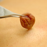 できもの（皮膚腫瘍）の治療