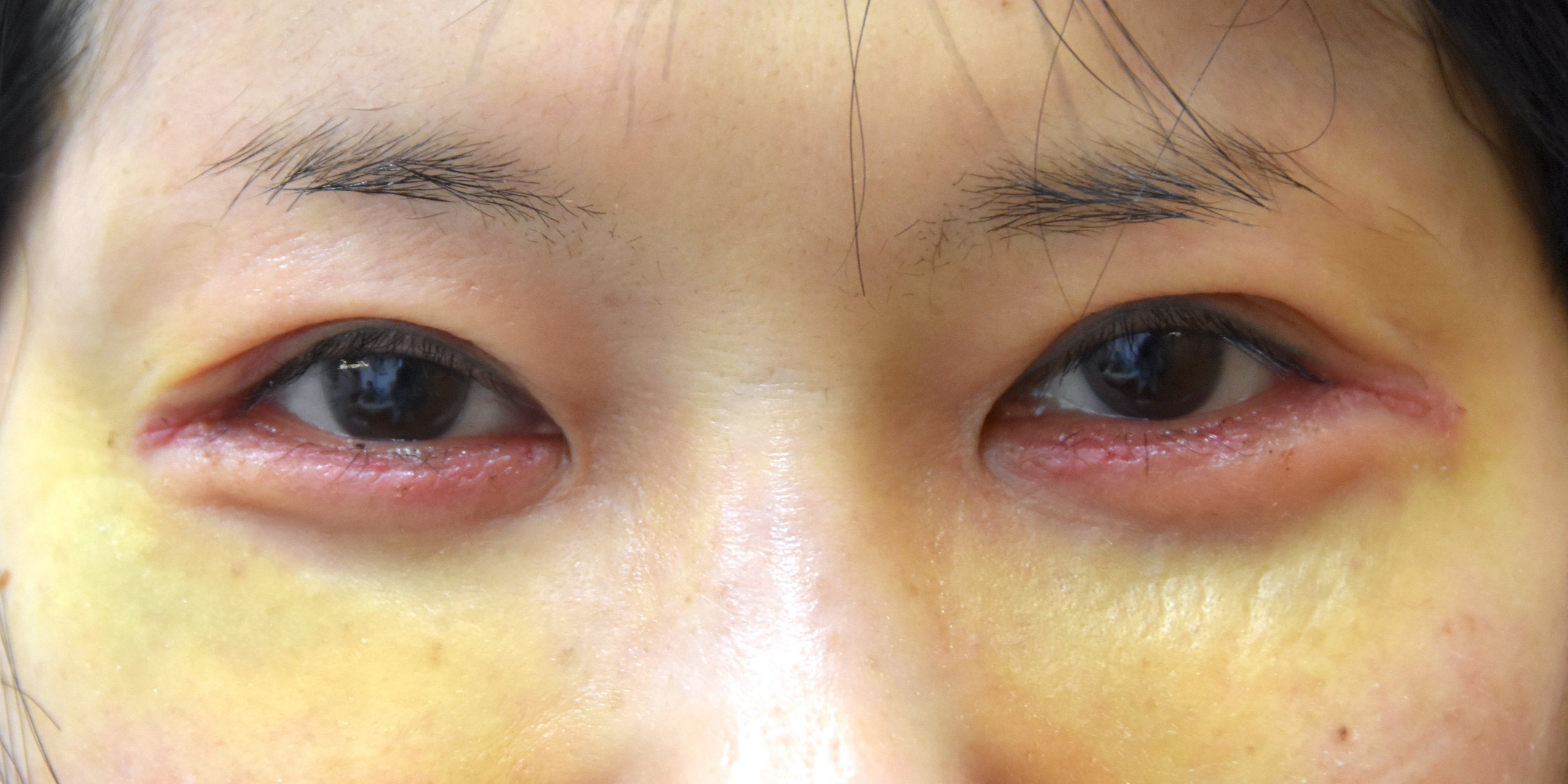 涙堂（涙袋）形成術術後　大江橋クリニック