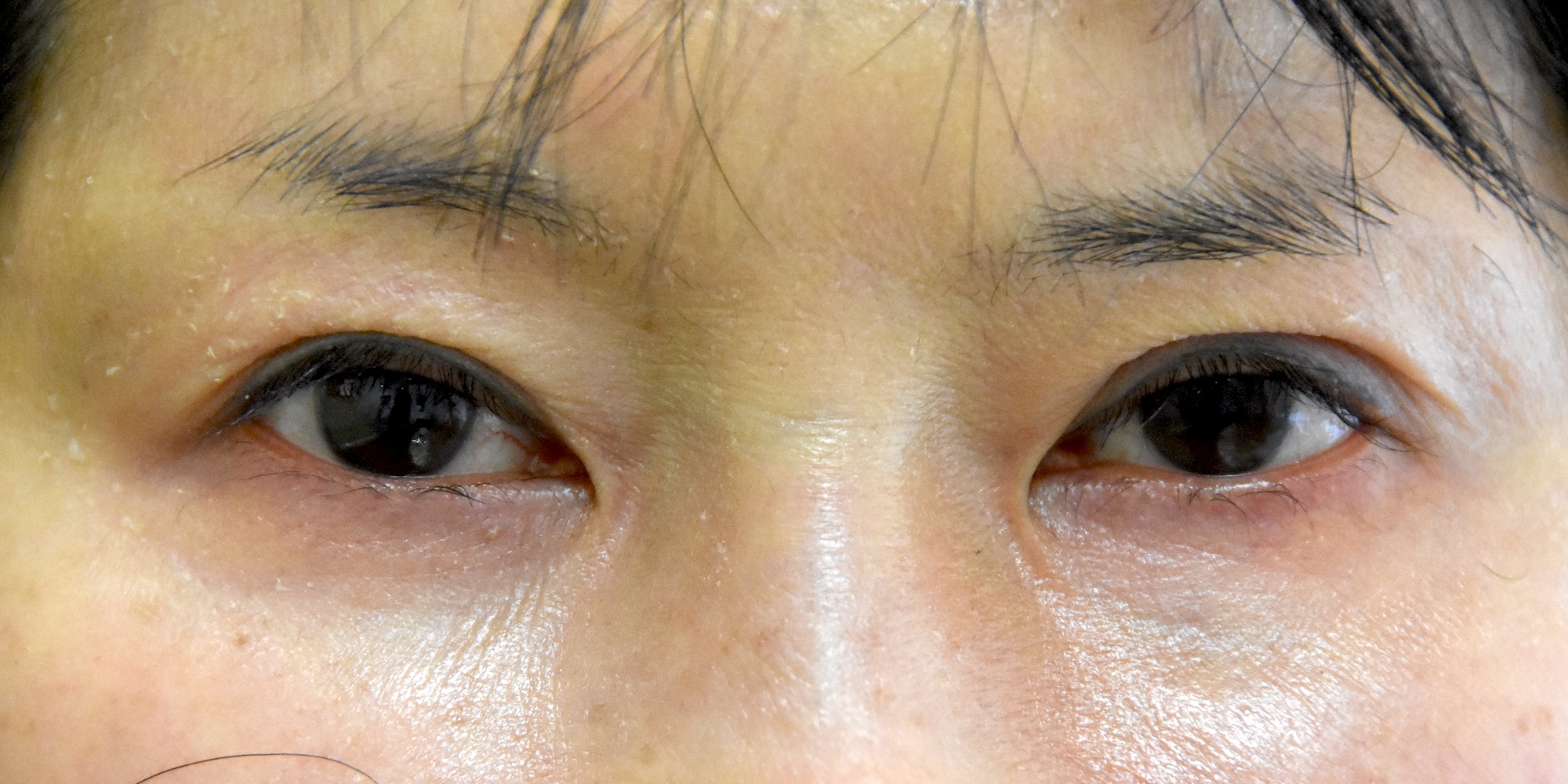 涙堂（涙袋）形成術術前　大江橋クリニック