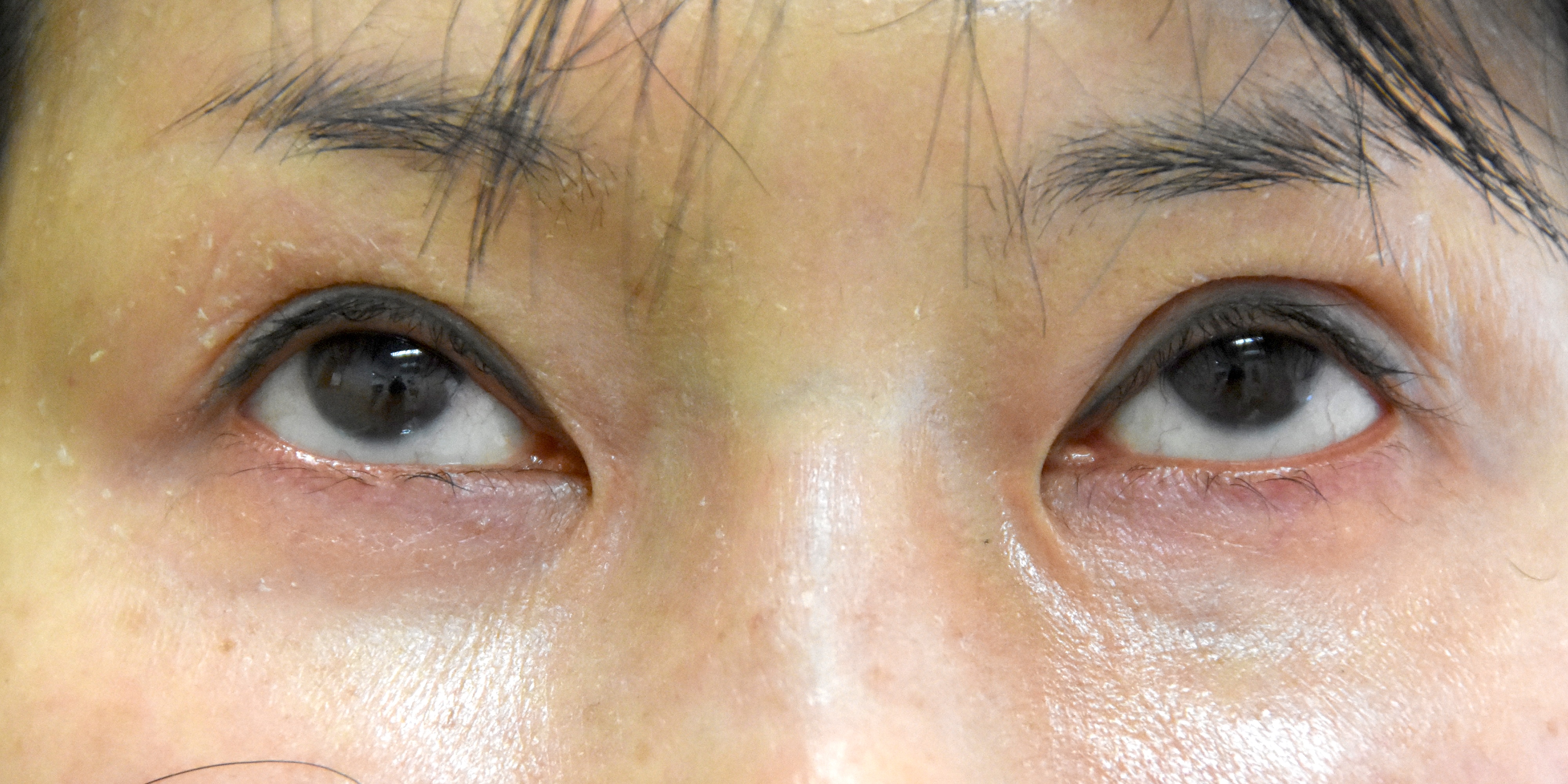 涙堂（涙袋）形成術術前上方視　大江橋クリニック