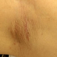 ワキガの手術の術後